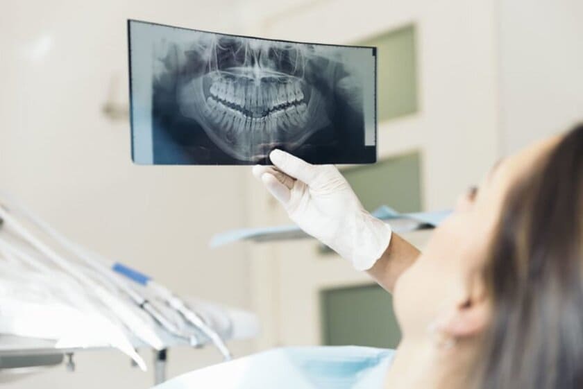 Máy chụp CT trong cấy ghép răng implant rất quan trọng