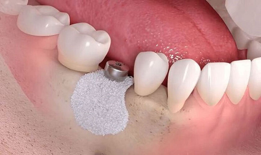 Cấy ghép implant là giải pháp phục hồi răng đã mất tối ưu nhất