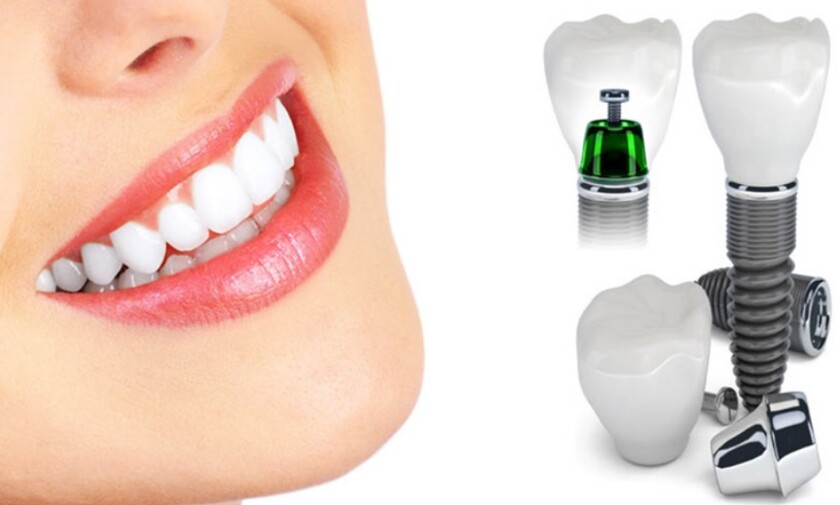 Trồng răng implant đem lại nhiều lợi ích vượt trội mà cầu răng sứ không có được