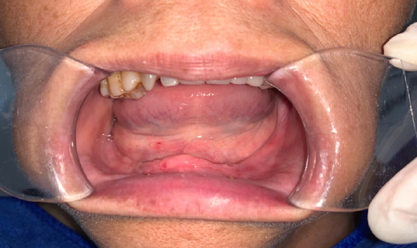 Cấy ghép Implant All on – 4 được chỉ định khi khách hàng bị răng toàn hàm