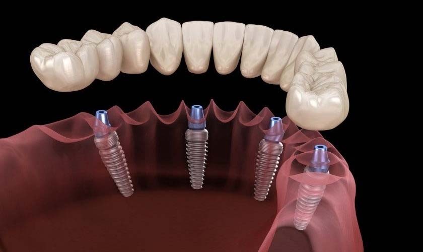 Cấy ghép implant là giải pháp phục hồi răng mất và cải thiện thẩm mỹ