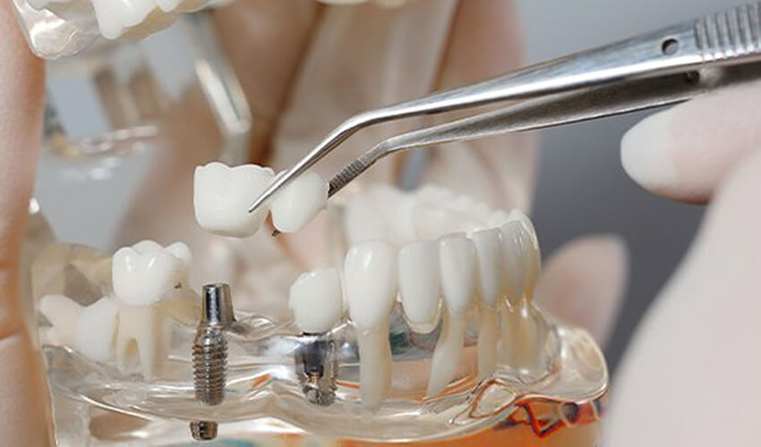 Kỹ thuật trồng răng implant là một trong những kỹ thuật tiên tiến nhất hiện nay được sử dụng trong phục hình răng