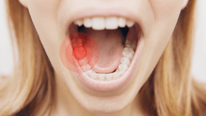 Răng Implant bị đau sau cấy ghép là hoàn toàn bình thường