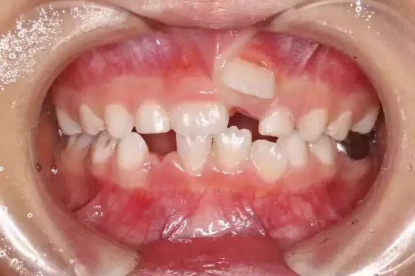 Răng mọc trên lợi là các răng mọc không đều, không đúng vị trí trong cung hàm