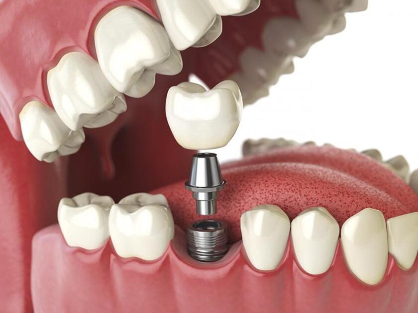 Trồng răng Implant là phương pháp phục hình răng mất phổ biến