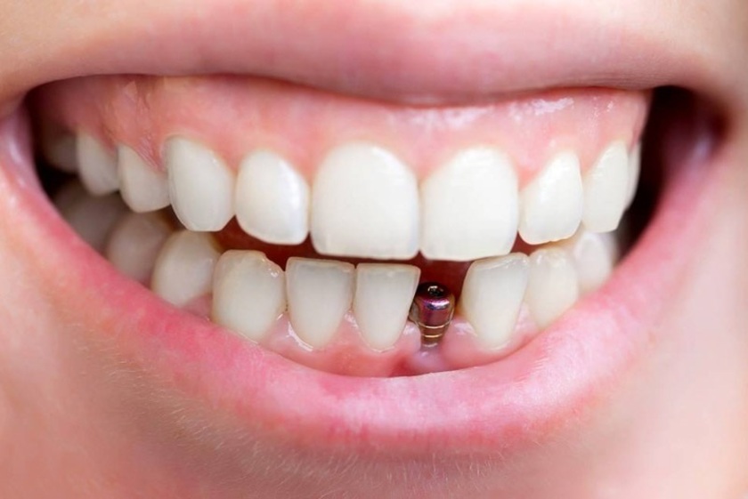 Cấy ghép răng có thể ngăn ngừa tiêu xương hàm hiệu quả