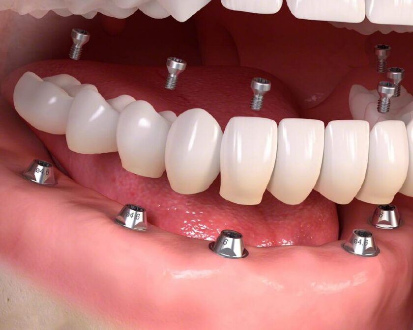 Trồng răng implant là phương pháp giúp phục hình lại những chiếc răng đã mất hiệu quả