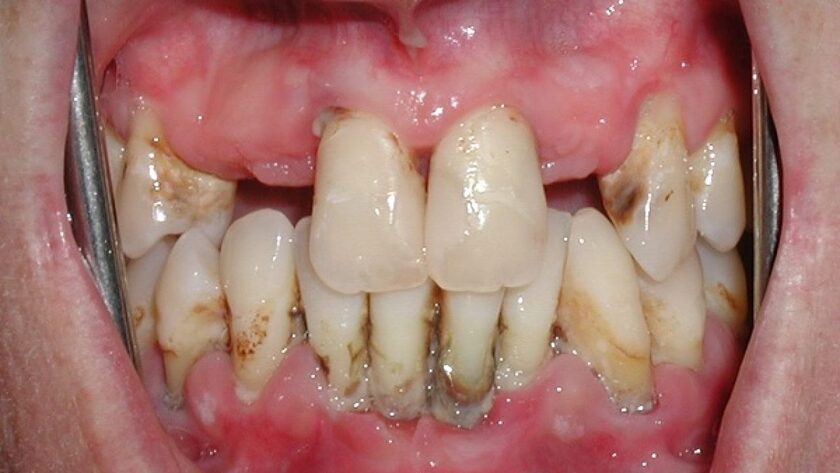 Viên nha chu nặng có thể phá hủy và tiêu xương ổ răng trầm trọng