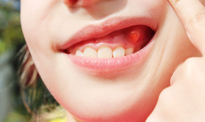 Sưng lợi răng hàm cần được điều trị sớm