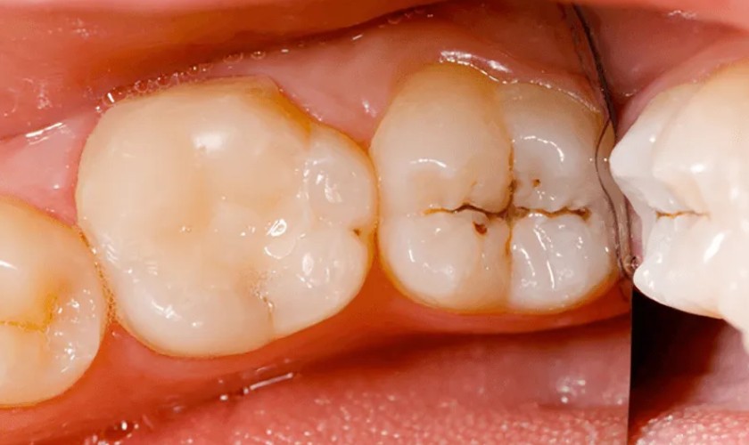 Sâu răng cũng là nguyên nhân gây sưng lợi răng hàm