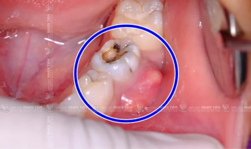 Sâu răng lớn gây nhiễm trùng tủy răng