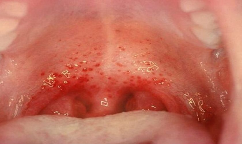 Viêm họng liên cầu khuẩn là nguyên nhân gây sưng hàm