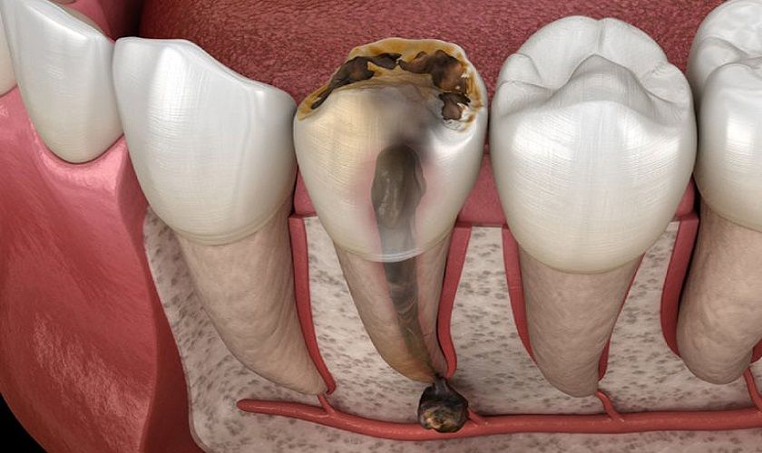 Nếu bạn mắc bệnh lý vùng tủy sẽ dẫn đến tình trạng viêm chân răng có mủ
