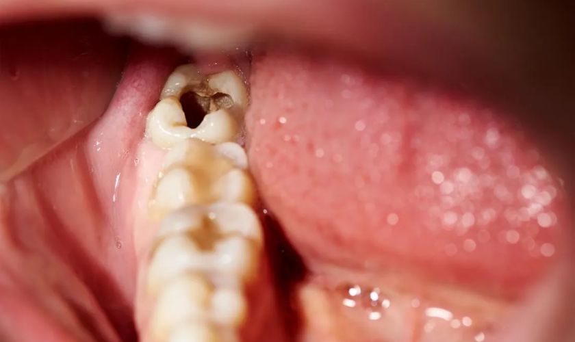 Răng khôn bị sâu gây nên tình trạng đau nhức