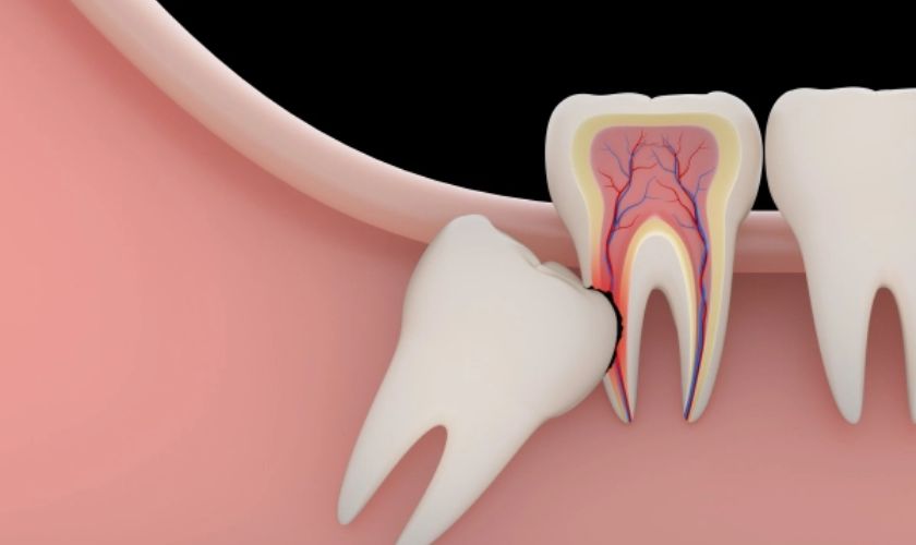 Khi răng khôn mọc lệch hoặc mọc sai vị trí cần nhổ răng