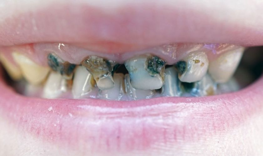 Sâu răng gây nên tình trạng đau răng