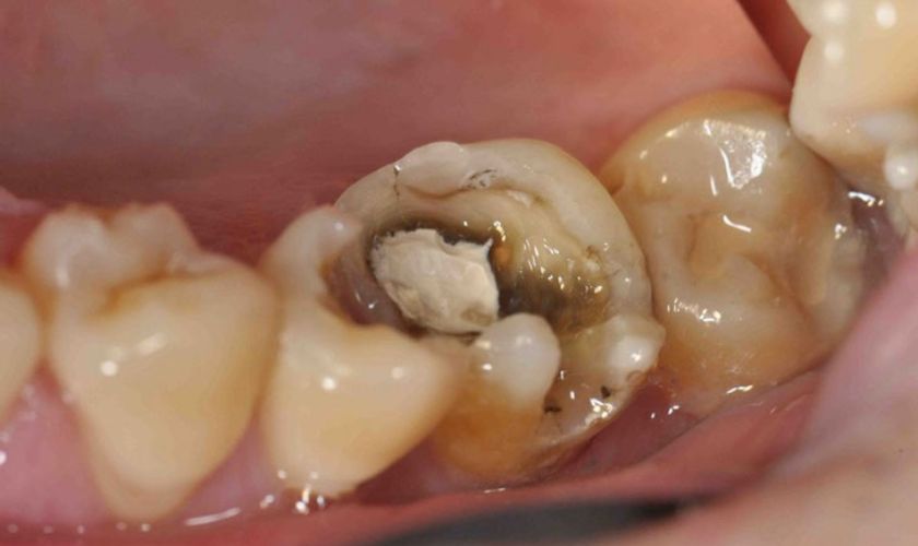 Viêm tủy gây nên tình trạng đau răng