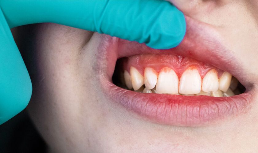 Bệnh về nướu gây nên tình trạng đau răng