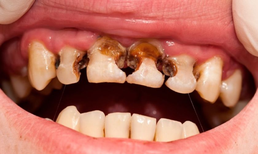 Sâu răng là nguyên nhân dẫn đến tình trạng đau răng nổi hạch