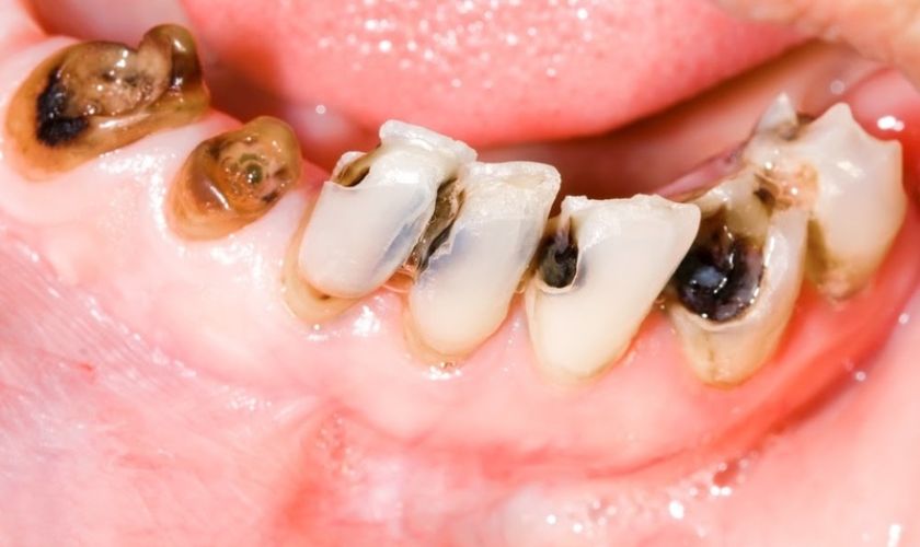 Sâu răng là nguyên nhân dẫn đến đau răng sưng má