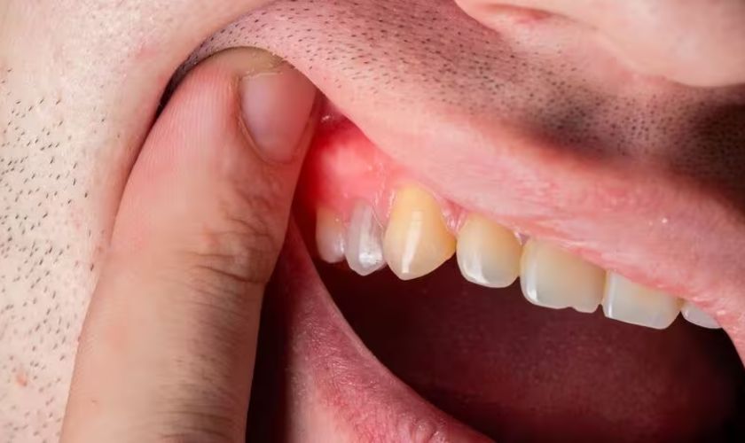 Sưng nướu răng nếu không điều trị kịp thời sẽ gây nên viêm nha chu, áp xe