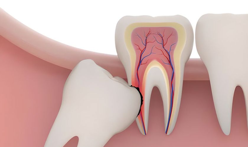 Nhổ răng khôn để giảm đau nhức răng