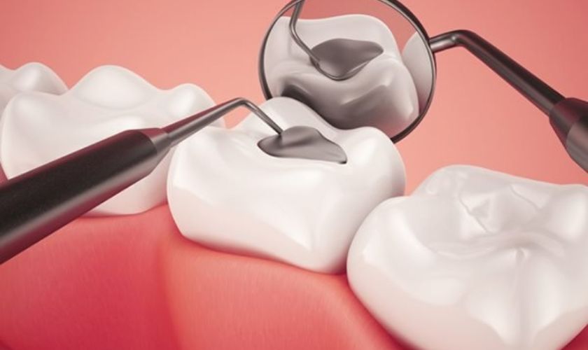 Trám răng để ngăn ngừa tình trạng đau răng