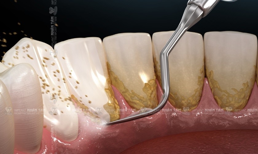 Các mảng bám vôi răng là nguyên nhân chủ yếu dẫn đến nướu bị viêm