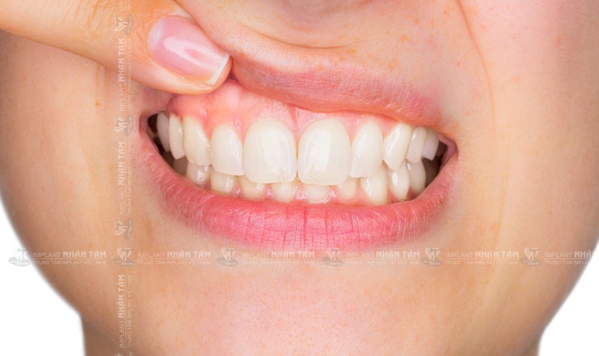 Viêm nướu răng là bệnh lý răng miệng rất dễ gặp