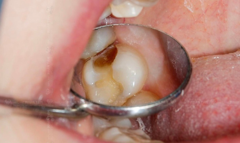 Sâu răng gây đau răng