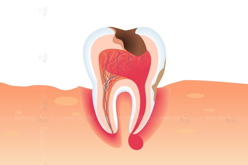 Áp-xe răng gây ra những cơn đau dữ dội