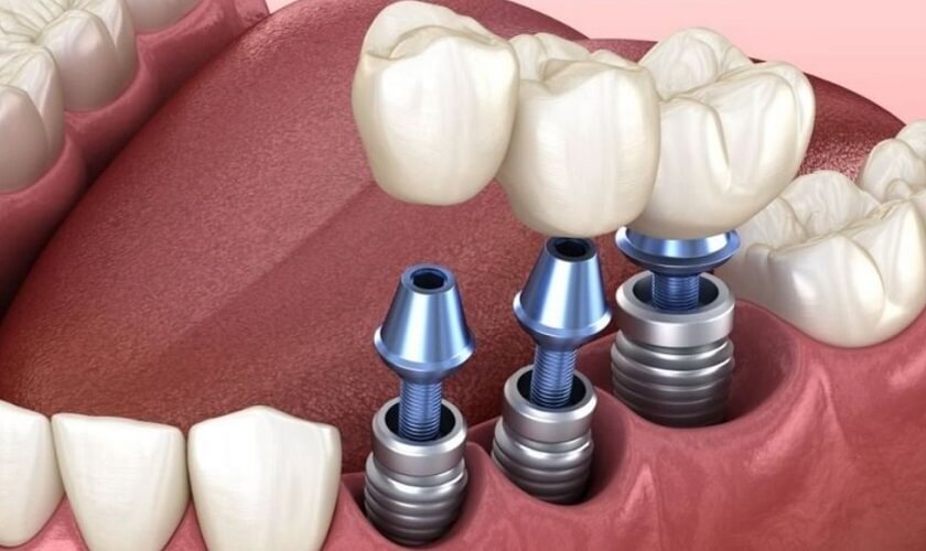 Kỹ thuật cấy răng implant tối ưu và hiệu quả cho mọi trường hợp mất răng