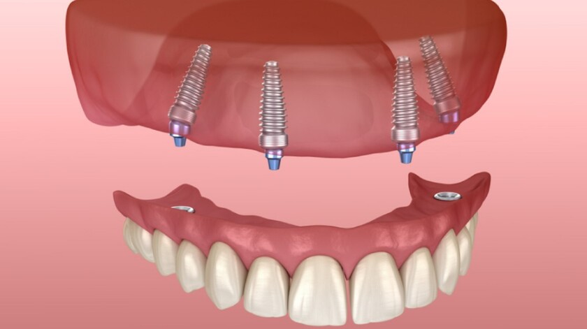 Hàm tháo lắp trên implant là sự kết hợp giữa phục hình tháo lắp và implant