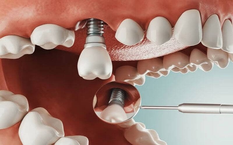 Cấy ghép Implant đảm bảo khả năng ăn nhai như răng bình thường