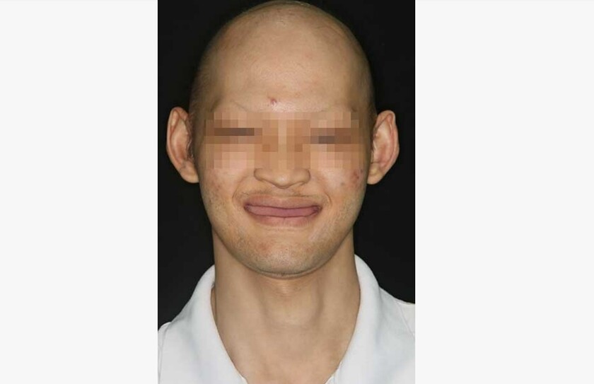 Bùi Quang Long mặc cảm vì không có răng bẩm sinh
