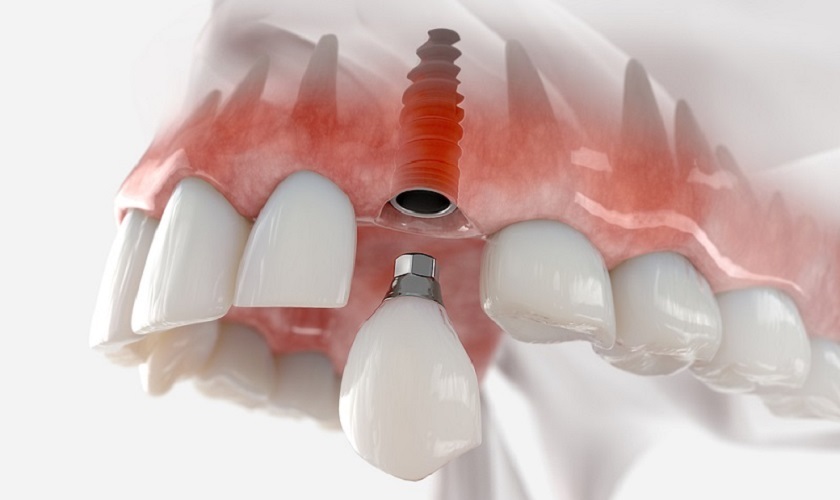 Trồng răng implant tức thời sẽ giúp rút ngắn thời gian điều trị