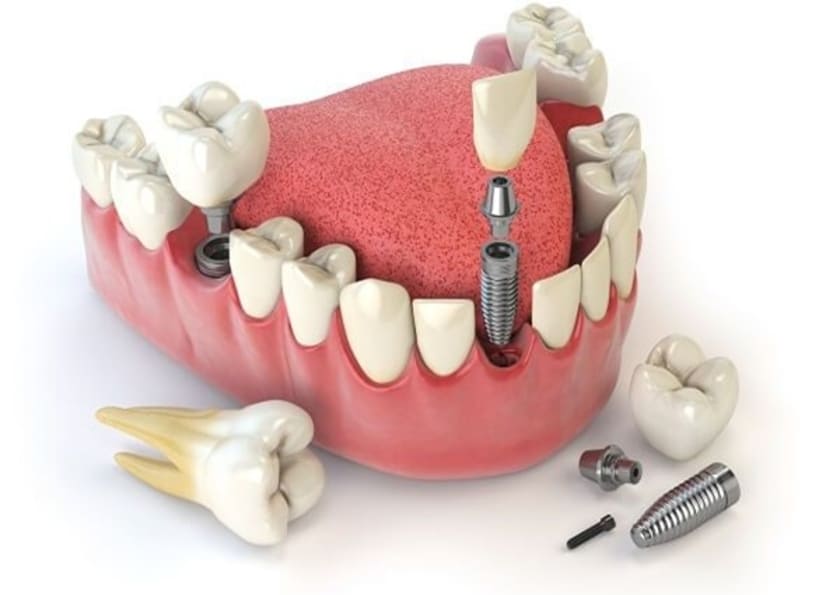 Trồng răng implant giúp phục hồi răng mất hiệu quả