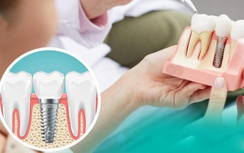Bảng giá cấy ghép implant còn phụ thuộc vào tình trạng răng miệng bệnh nhân