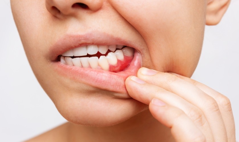 Dấu hiệu nhận biết sưng nướu răng