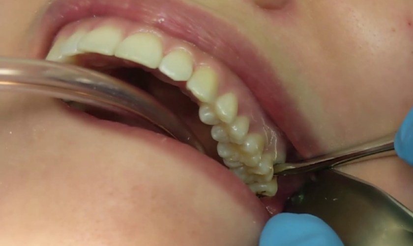 Nhổ răng khôn trong trường hợp răng khôn mọc lệch là rất cần thiết