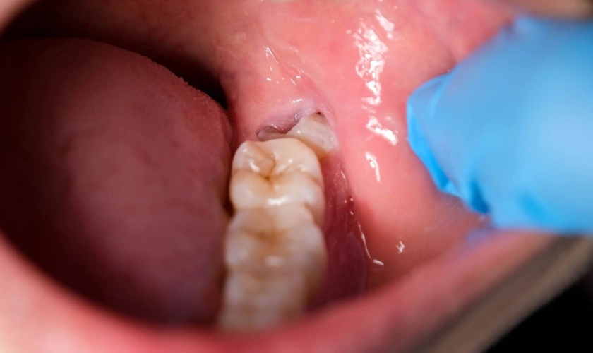 Răng khôn mọc có thể gây sưng nướu răng