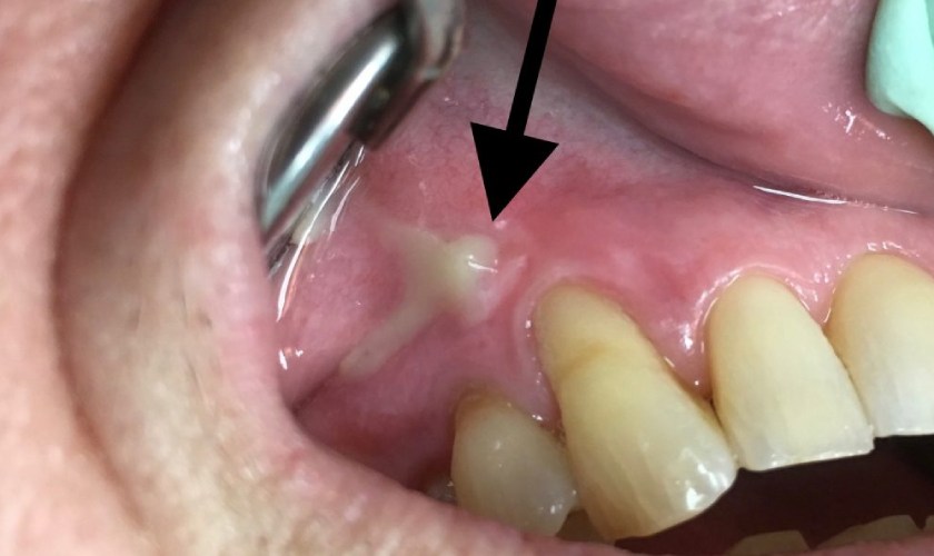 Triệu chứng của sưng nướu răng