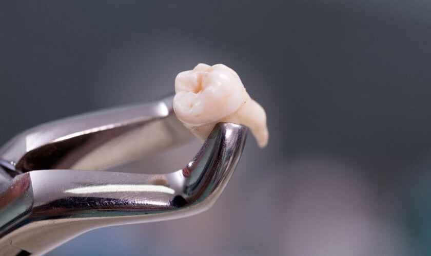 Sưng nướu răng trong cùng hàm trên nếu không được khắc phục kịp thời có thể gây mất răng
