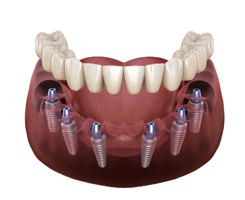Trồng răng Implant toàn hàm mang đến nhiều lợi ích thiết thực