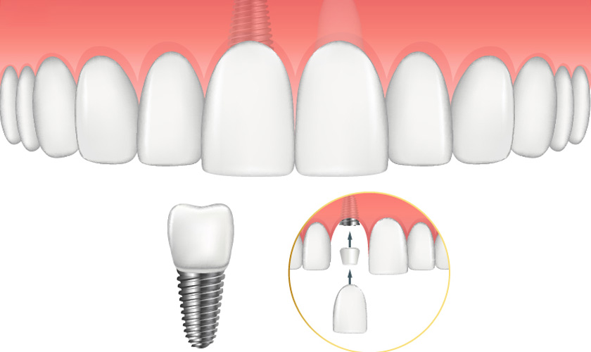 Trồng răng implant có nhiều ưu điểm vượt trội hơn hẳn