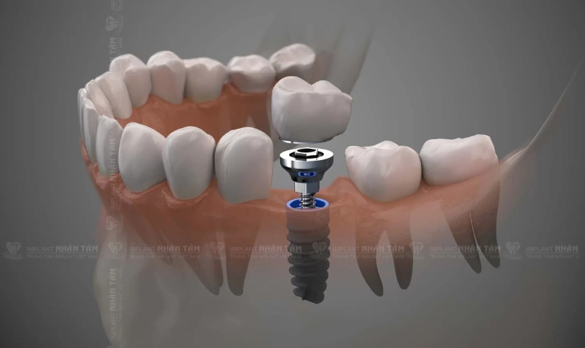 Trồng răng Implant là giải pháp tối ưu nhất để phục hình răng số 6 bị mất