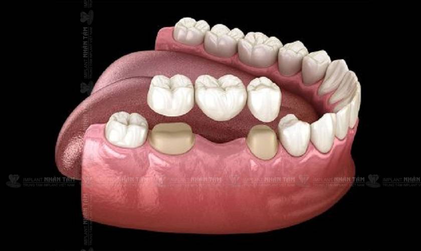 Điều trị mất răng số 6 bằng cầu răng sứ