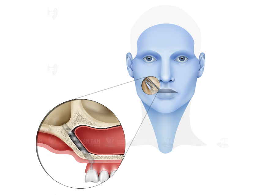 Vị trí đặt Implant xương bướm