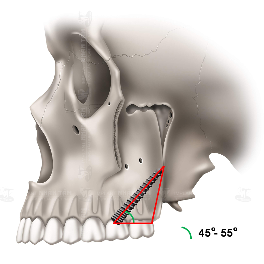 Implant xương bướm phù hợp với bệnh nhân bị tiêu xương hàm trên nghiêm trọng