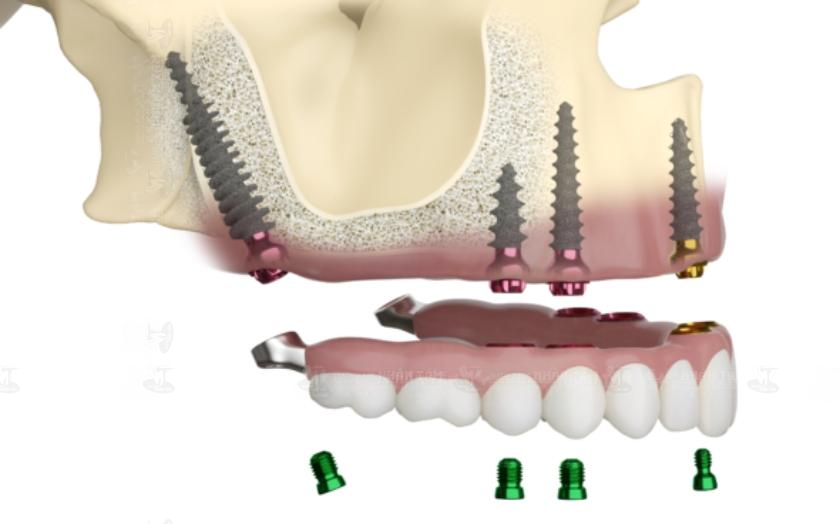 Cấy ghép Implant xương bướm loại bỏ nhu cầu thực hiện thủ thuật nâng xoang hoặc ghép xương